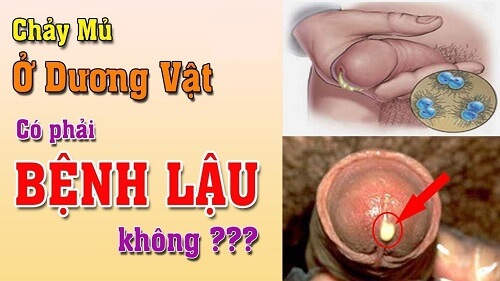 Dương vật chảy mủ 